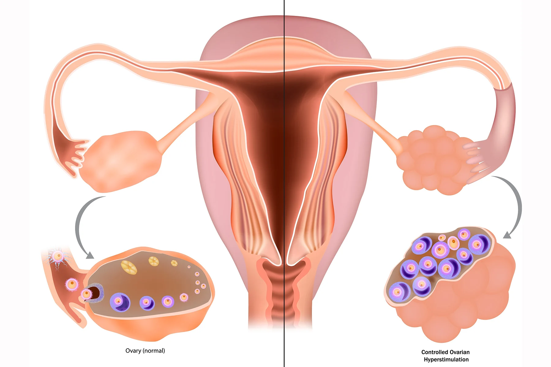 Controlled Ovarian Stimulation COS or Controlled ovarian hyperstimulation COH for IVF. Selecting the ideal protocol